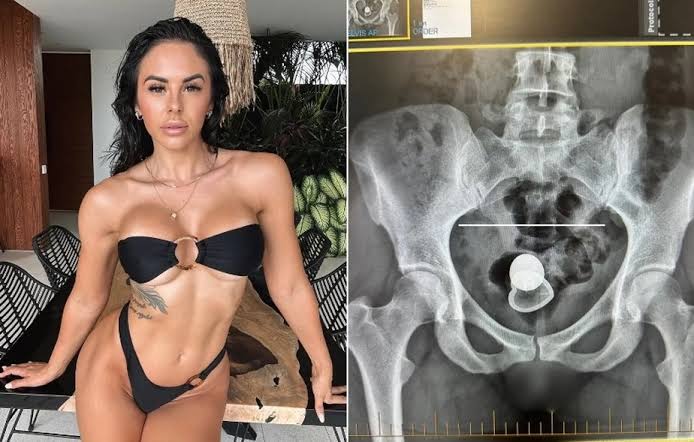 “Unfortunate sex mishap”: X-ray reveals surprisingly common hospital emergency